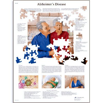 3B Scientific Alzheimers Disease Anatomical Anatomy Chart Poster Heavy 